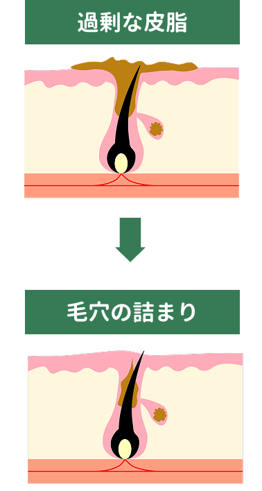 過剰な皮脂→毛穴の詰まり