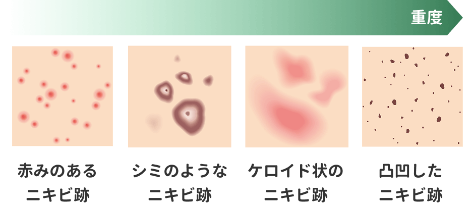軽度→重度・赤みのあるニキビ跡→シミのようなニキビ跡→ケロイド状のニキビ跡→凹凸したニキビ跡