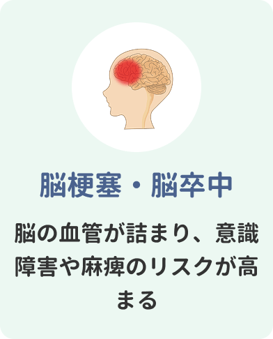 脳梗塞・脳卒中　脳の血管が詰まり、意識障害や麻痺のリスクが高まる