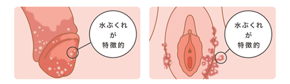 水ぶくれが特徴的
