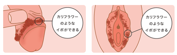 カリフラワーのようなイボができる