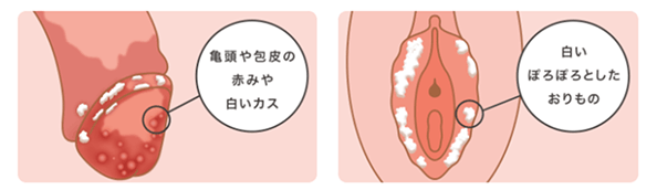 亀頭や包皮の赤みや白いカス・白いぽろぽろとしたおりもの